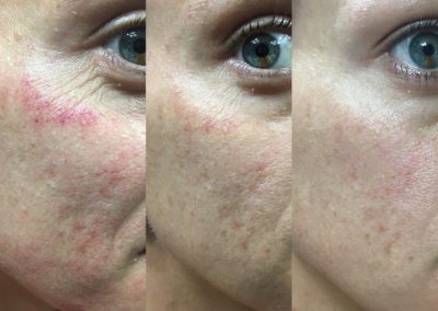 Microneedling Healing Process