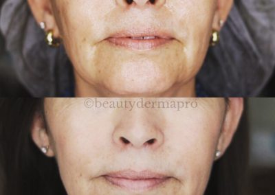Microneedling Before & After 1 procedure