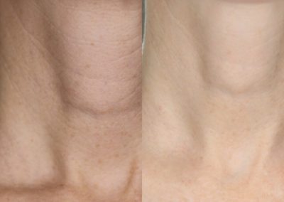 Microneedling Neck Before & After 4 treatments