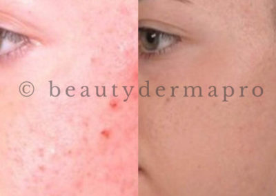 Microneedling Acne Treatment Before & After 1 procedure